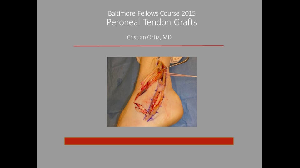 Baltimore Fellows Course 2015: Peroneal Tendon Allografts