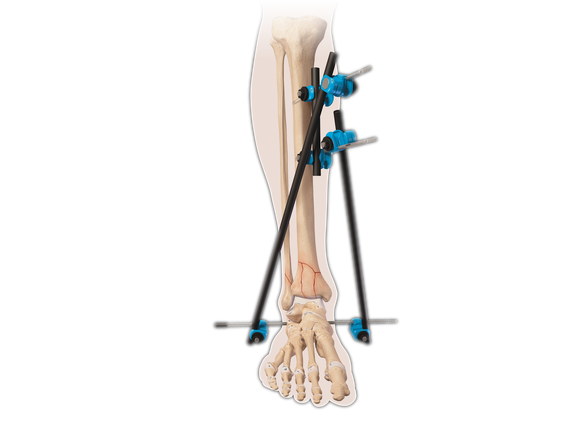 ArthroFX® System