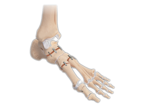 DynaNite Nitinol Staples
