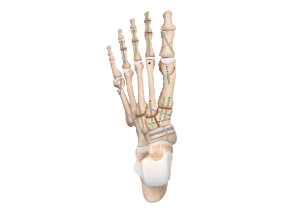 Snap-Off Compression FT Pins